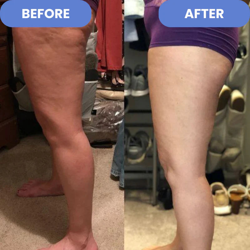 ProSculpt™ - Cellulite Treatment 4-in-1 -EBOOK GRATUITO
