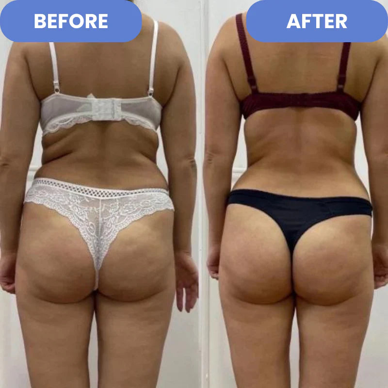 ProSculpt™ - Cellulite Treatment 4-in-1 -EBOOK GRATUITO