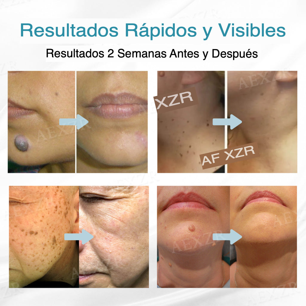 NeoLaser™- Láser no invasivo para eliminar lunares y verrugas